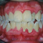 antes 2