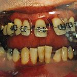 antes 3