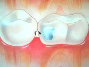 Cárie Interproximal